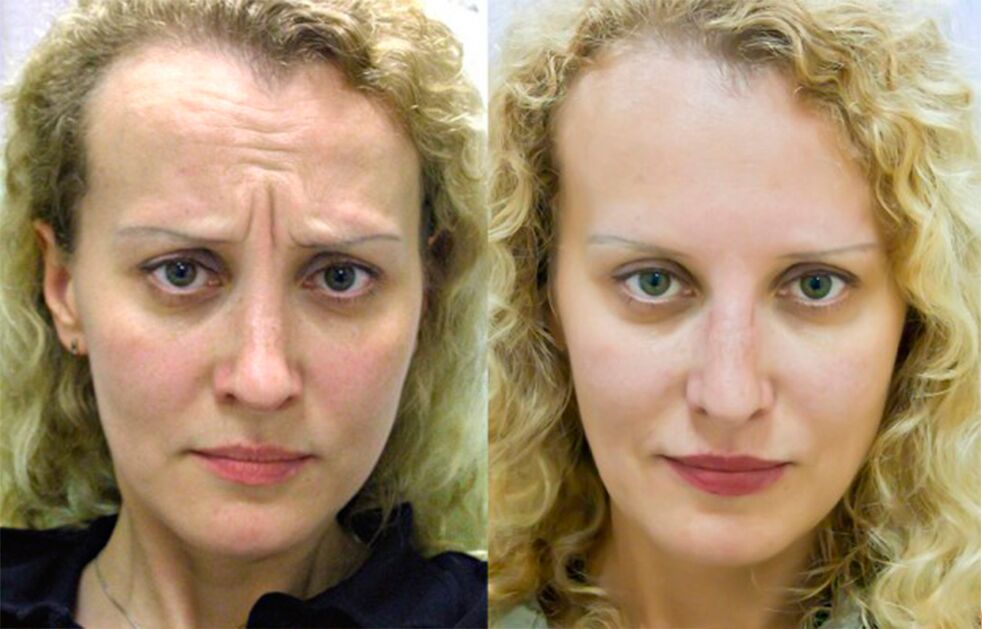 před a po použití masážního přístroje pro omlazení ltza foto 1