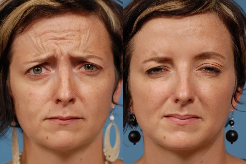 před a po použití masážního přístroje pro omlazení ltza foto 2