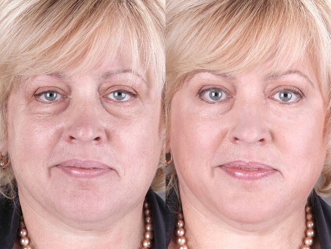 před a po použití masážního přístroje pro omlazení ltza foto 3