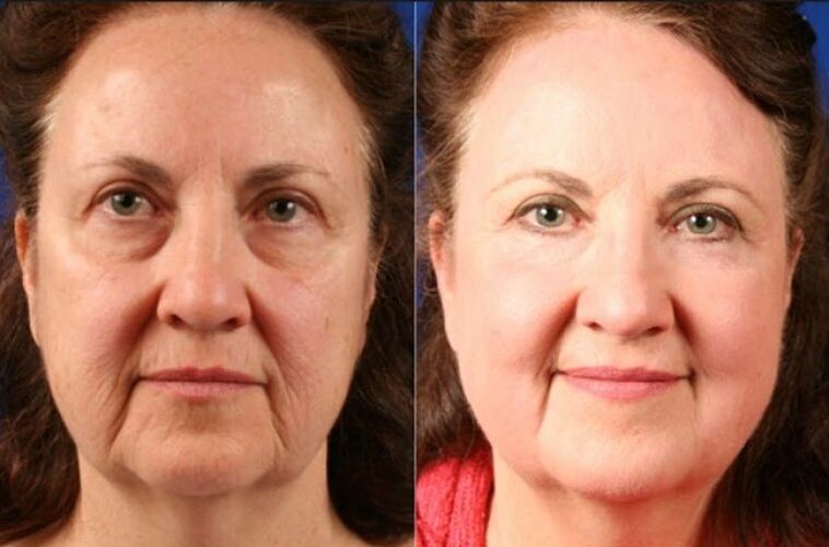 před a po použití masážního přístroje pro omlazení ltza foto 6