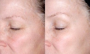 omlazení pokožky kolem očí před a po fotografiích