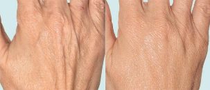 Kůže ruky před a po frakční terapii