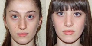 před a po omlazení pokožky plazmou